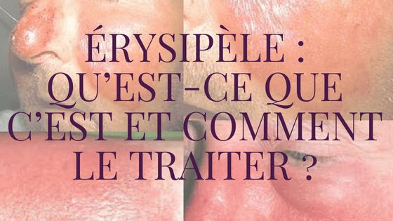 Érysipèle : Comment soigner un erysipele naturellement en 7 jours ?