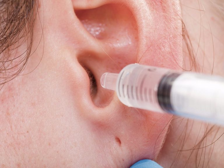 Bouchon dans l'oreille : Comment enlever le cérumen naturellement