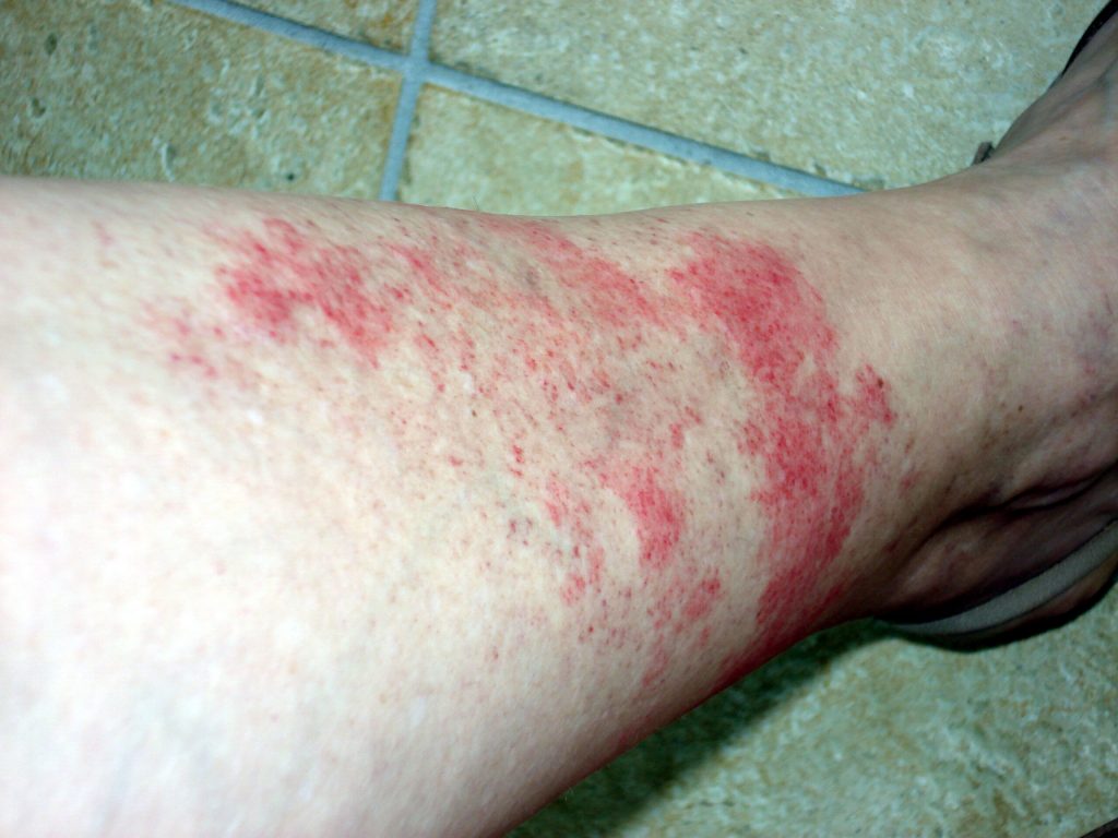 Eczéma variqueux : Top traitements naturels pour s’en débarrasser
