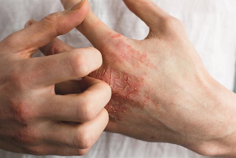 eczéma allergique de contact