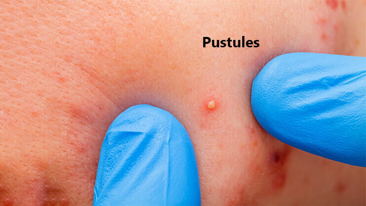 pustules