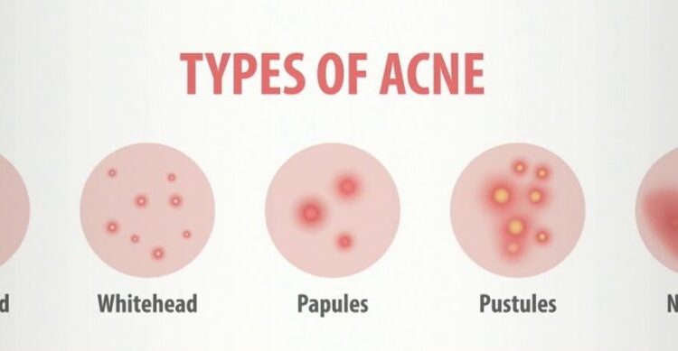différents types d'acné