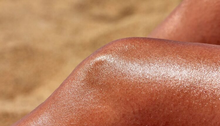 Cellulite sur les cuisses : aspect peau d'orange typique