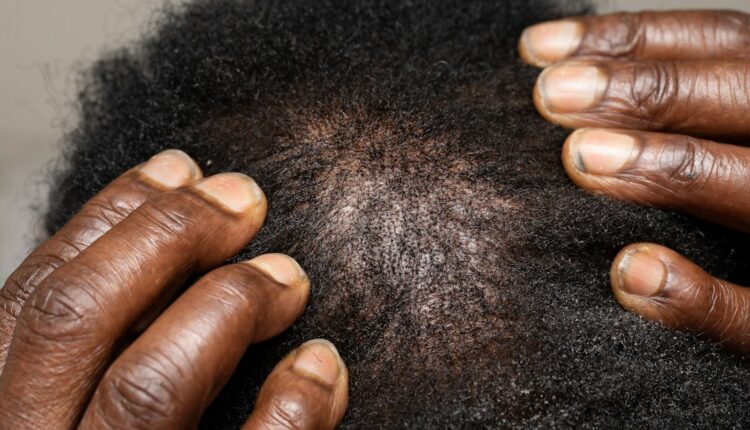 Croûtes cuir chevelu : examen de la peau du crâne pour identifier la cause