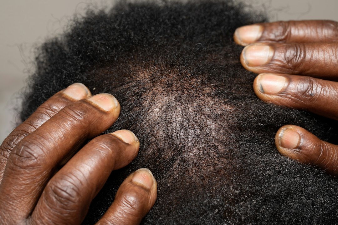 Croûtes cuir chevelu qui démangent : 7 causes et solutions naturelles Croûtes cuir chevelu : examen de la peau du crâne pour identifier la cause