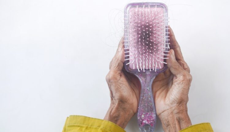 Perte de cheveux femme : brosse remplie de cheveux tombés