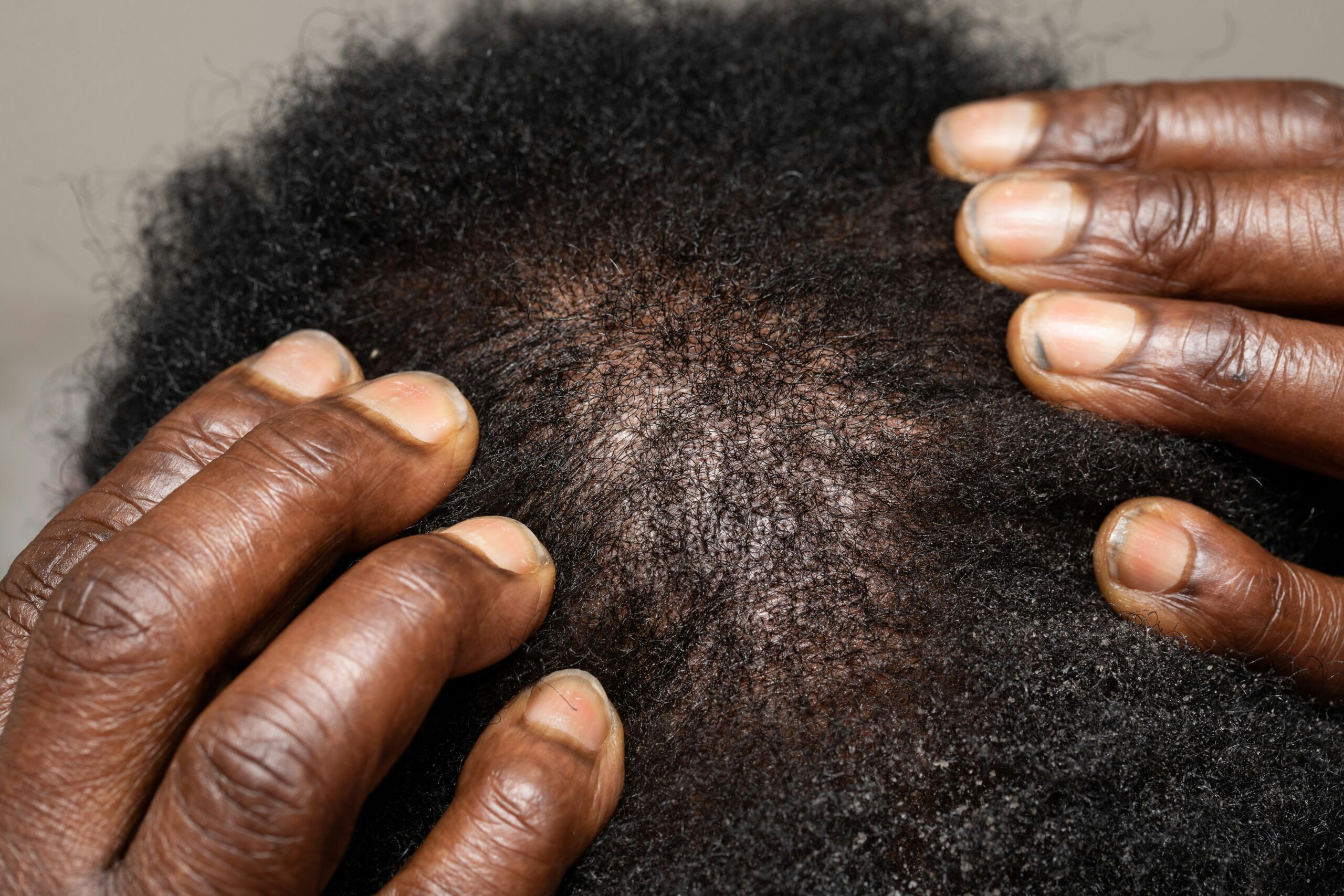 Eczéma Cuir Chevelu : 7 Solutions Naturelles Efficaces Eczéma cuir chevelu : cuir chevelu irrité nécessitant des soins naturels